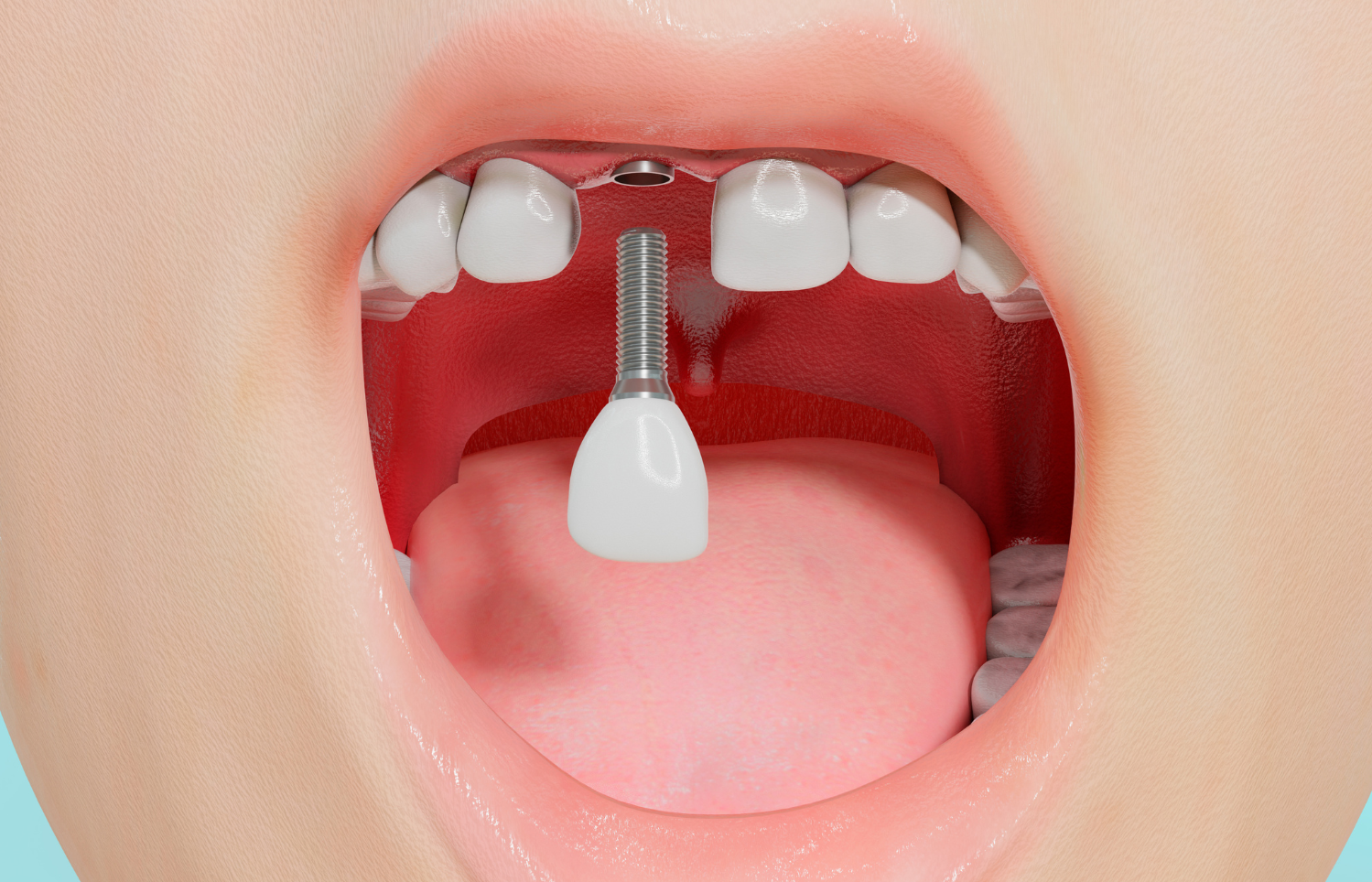 dental implant-missing tooth-antalya-turkey