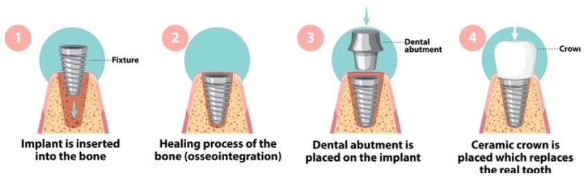 Stages Of Dental Implants In Turkey