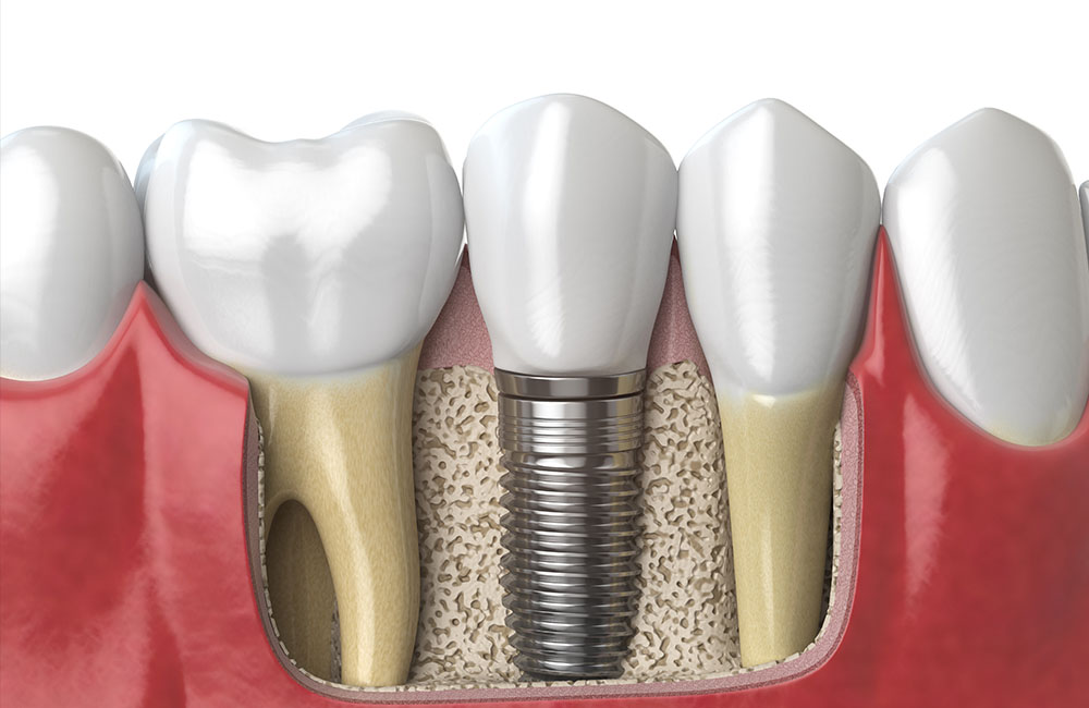 dental-implant in the jawbone
