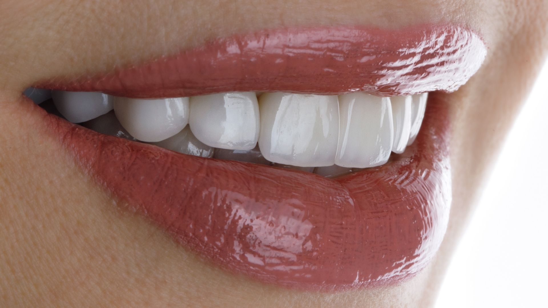 Dental veneers in Turkey, Antalya 