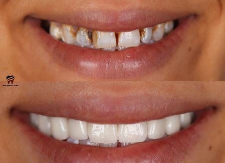 how-is-e-max-dental-crown-treatment-done-in-turkey