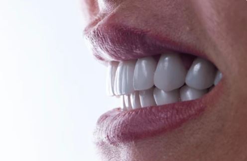 are-emax-crowns-veneers-worth-it-turkey-antalya