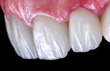 Are emax veneers worth it? in turkey