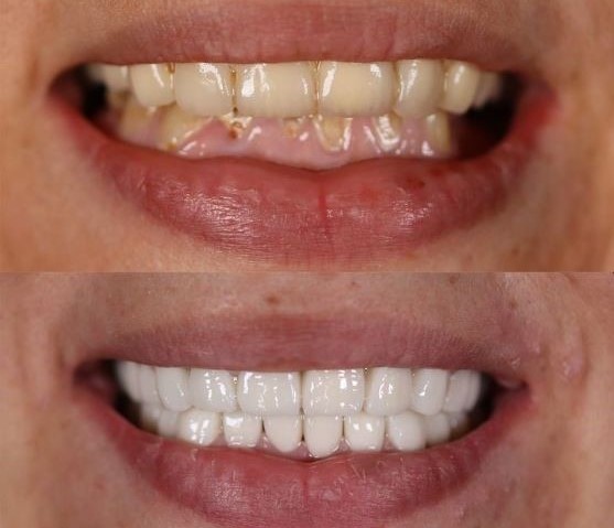 the-process-for-emax-veneers-turkey-antalya