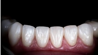 what is emax-veneer-antalya-turkey