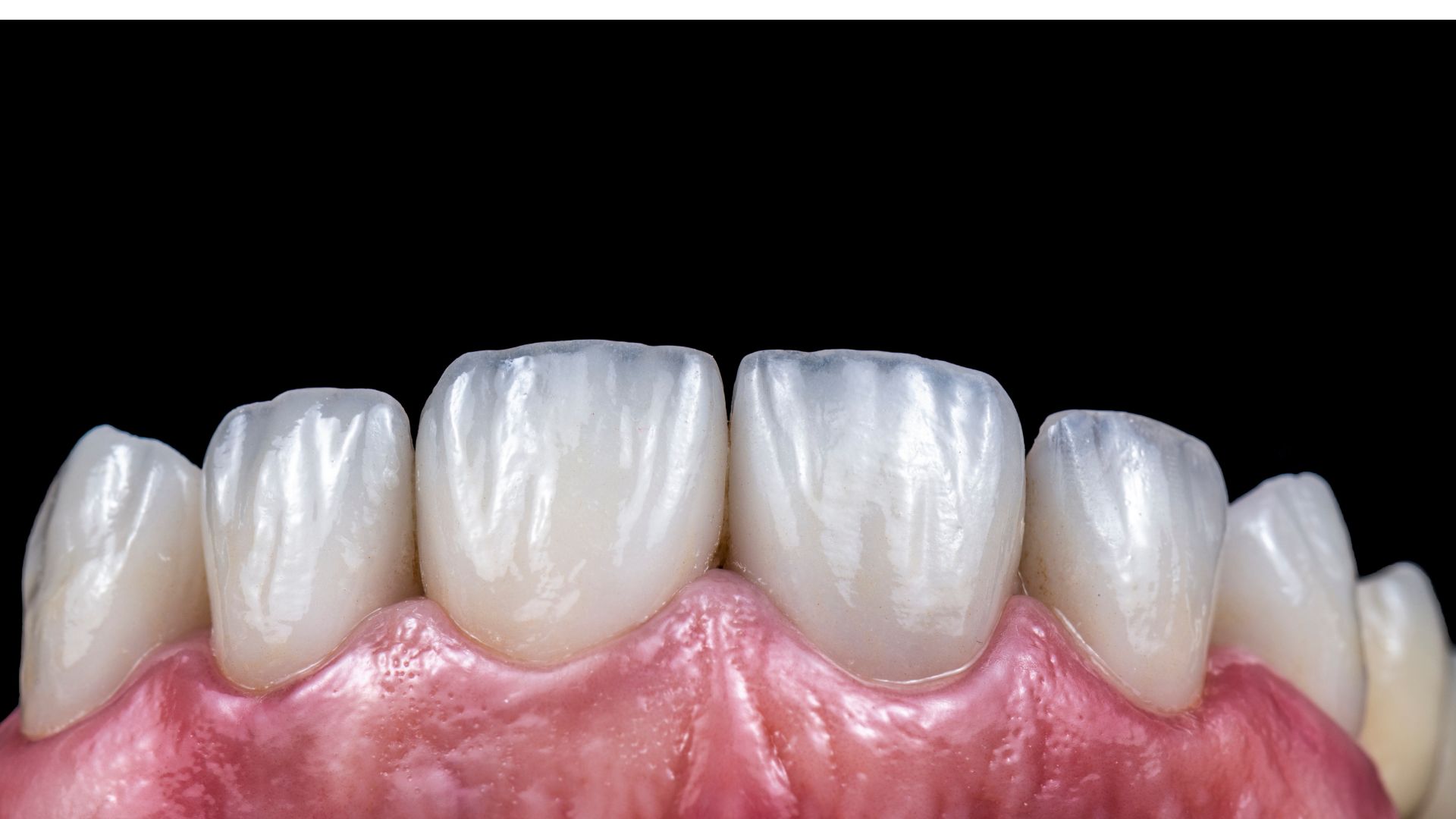 What are advantages&disadvantages of emax veneer in Antalya Turkey?