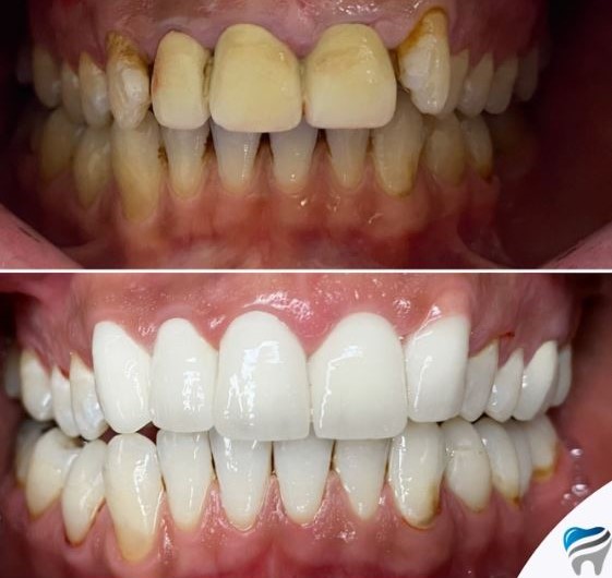 what-is-the-process-of-laminate-dental-veneers-turkey