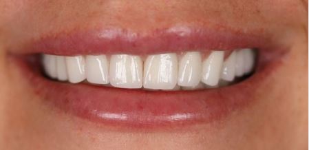 dos-and-donts-of-getting-laminate-dental-veneers-in-turkey