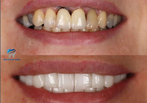 how-long-do-laminate-veneers-take-and-last-in-turkey