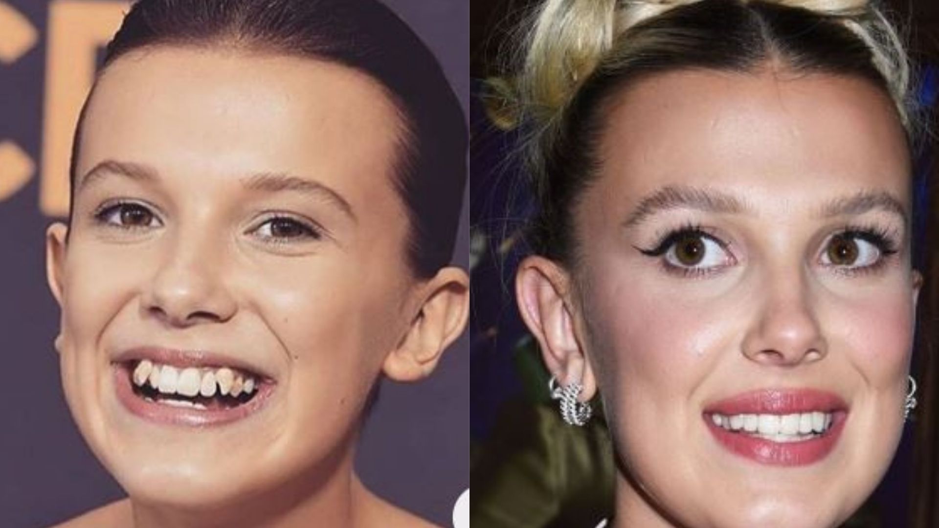 Did Millie Bobby Brown get dental procedures? 