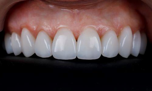 porcelain-veneers-antalya-turkey