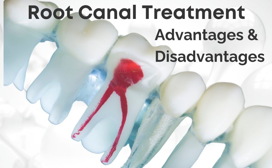 root-canal-treatment-advantages-and-disadvantages