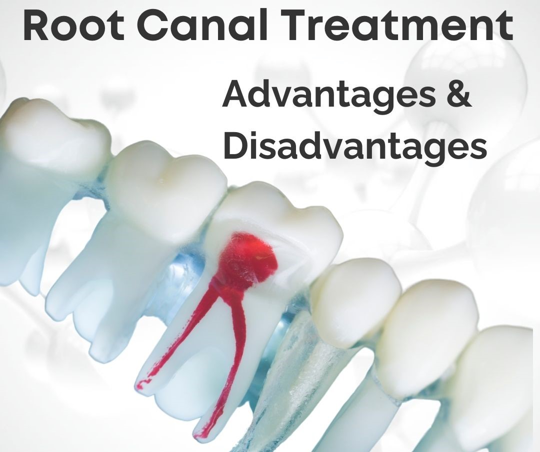 Advantages and Disadvantages of Root Canal in Antalya Turkey