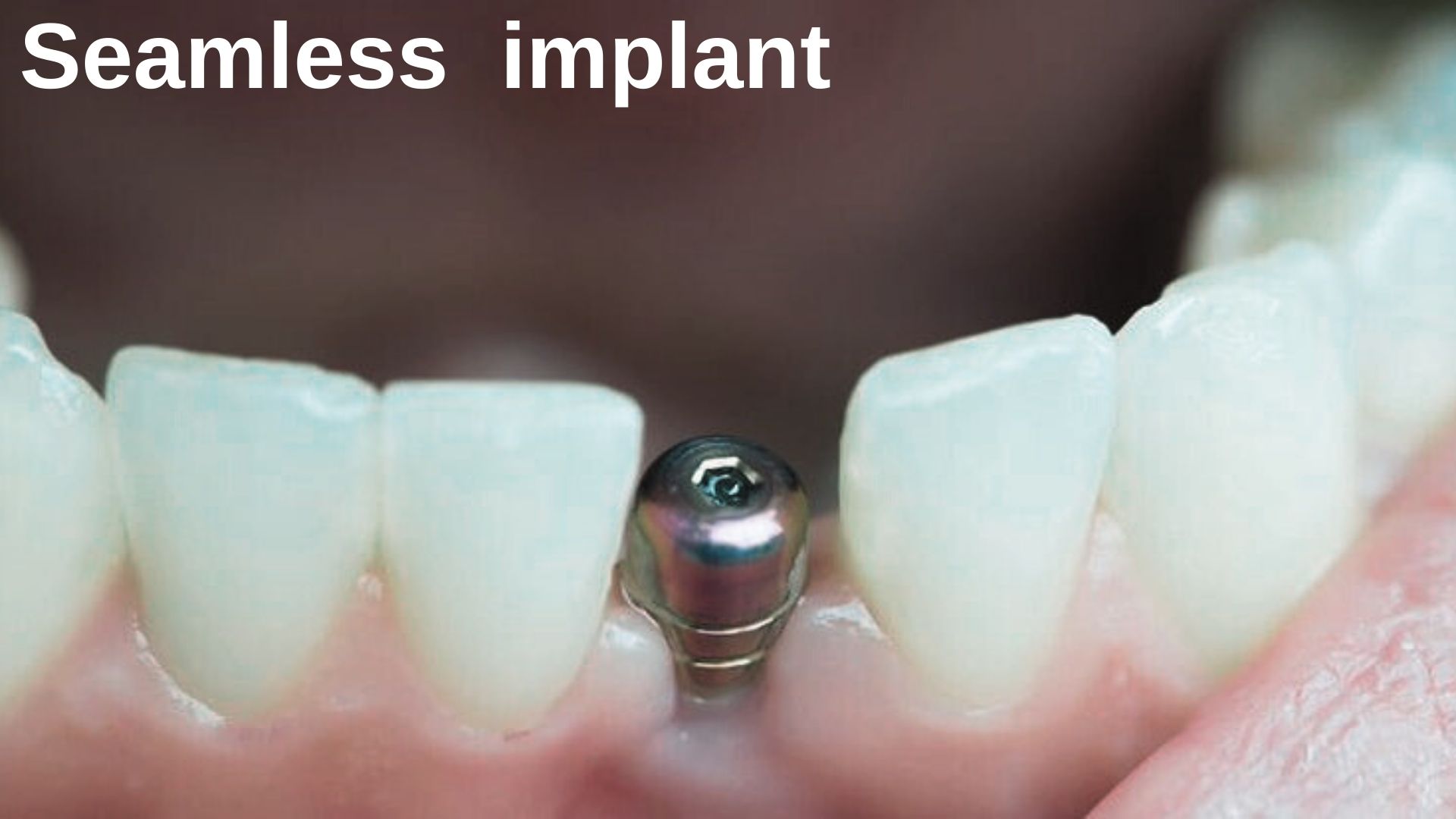 what-is-a-seamless-dental-implant-turkey-antalya