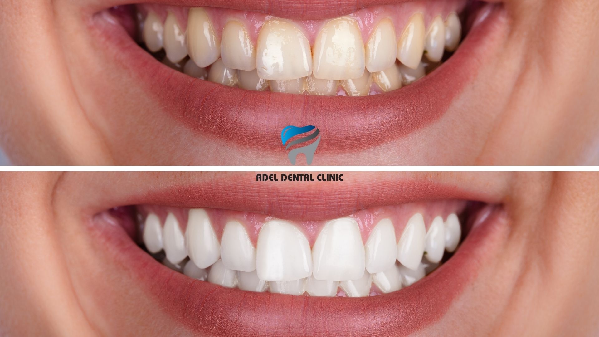 Who is a good candidate for teeth whitening? in Antalya Turkey