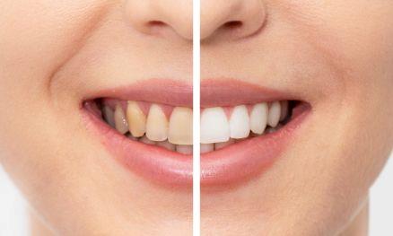 what is teeth-whitining
