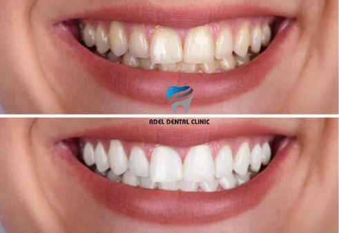 how-much-does-teeth-whitening-cost-in-turkey