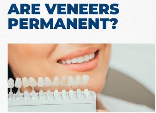 dental veneer