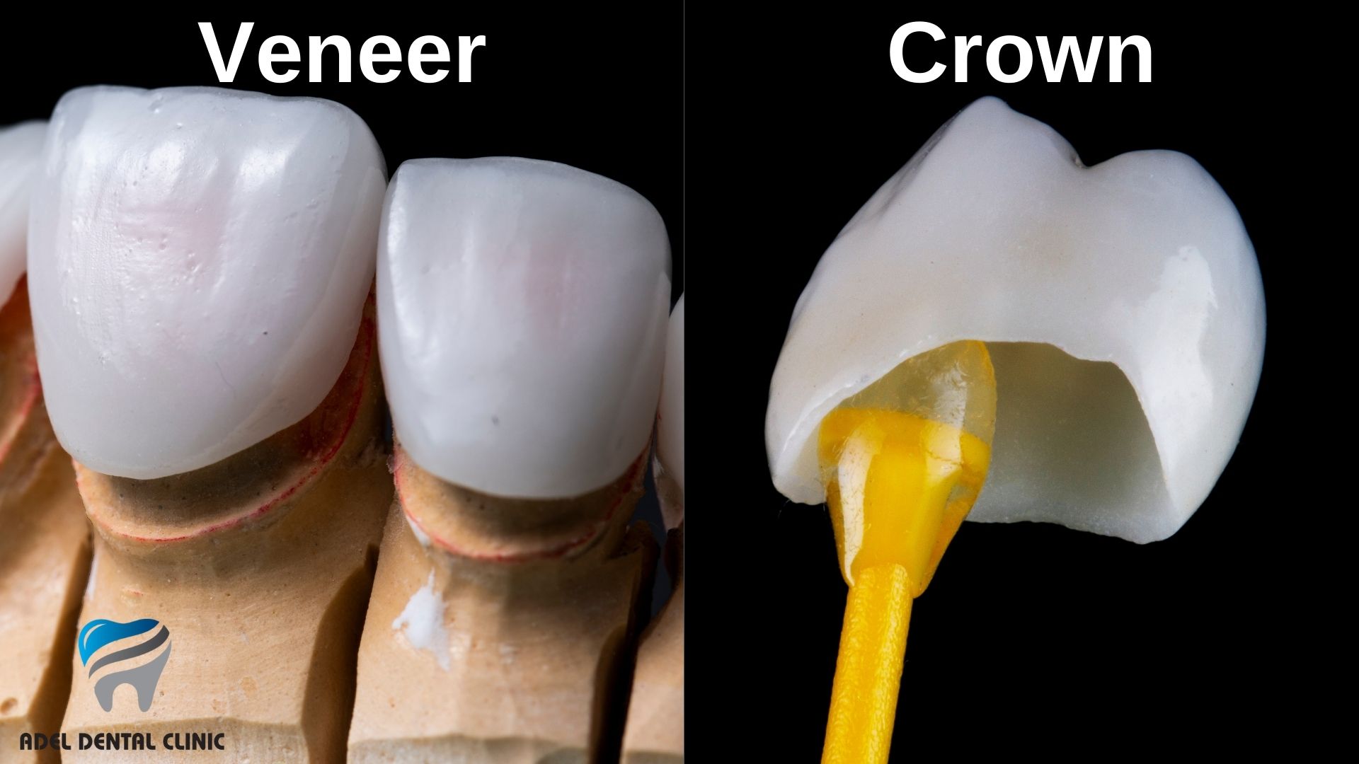 crowns-vs-veneers-turkey-antalya