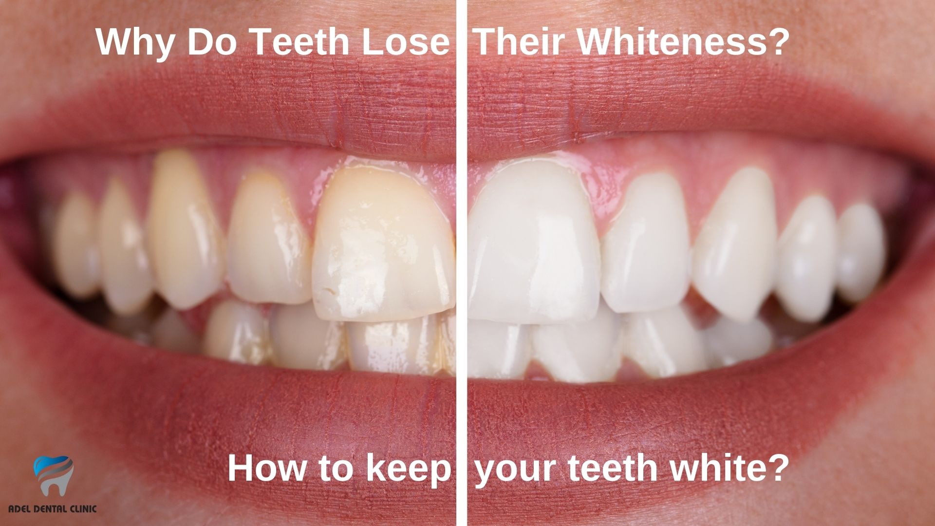 why-do-teeth-lose-whiteness