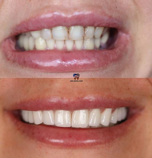 Advantages of Zirconia Crowns in Turkey