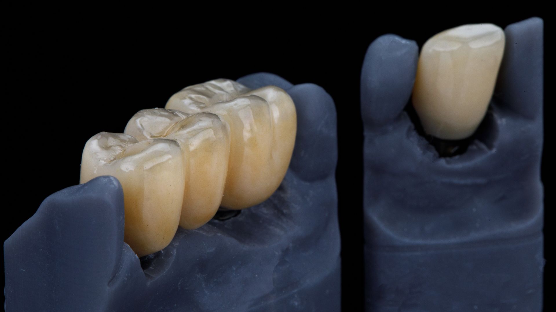 What is the difference of zirconia crown from other crowns?