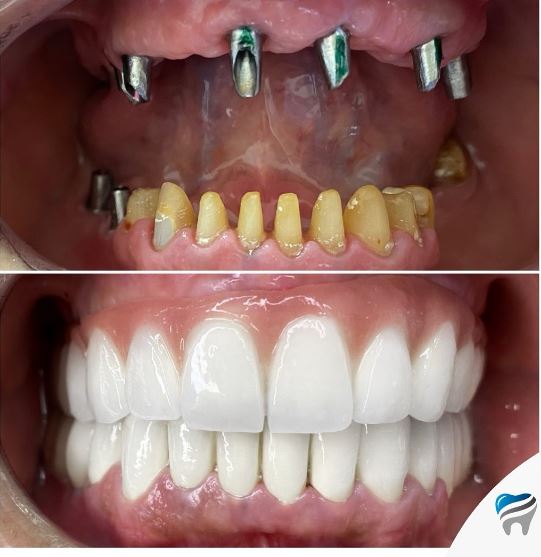 zirconium-crown-1-antalya-turkey